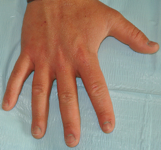 Darier’s Disease | SpringerLink