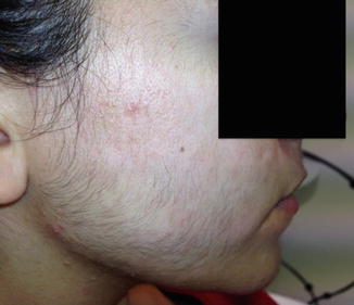 Spironolactone For Facial Hair