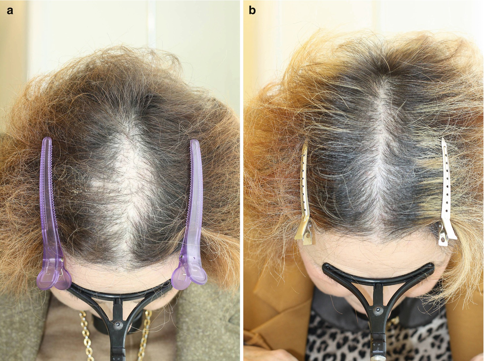 Androgenetic Alopecia  SpringerLink