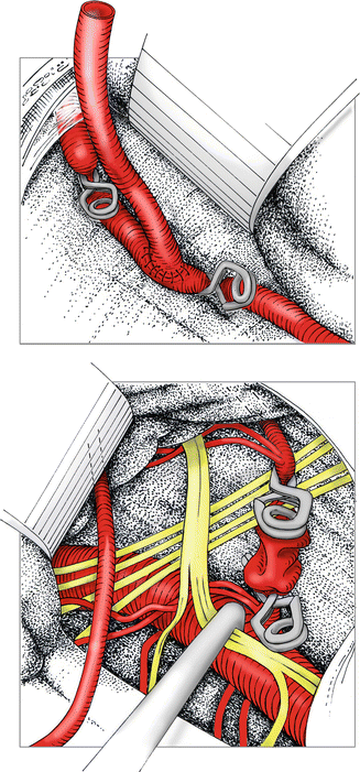 pica artery anatomy pica artery anatomy
