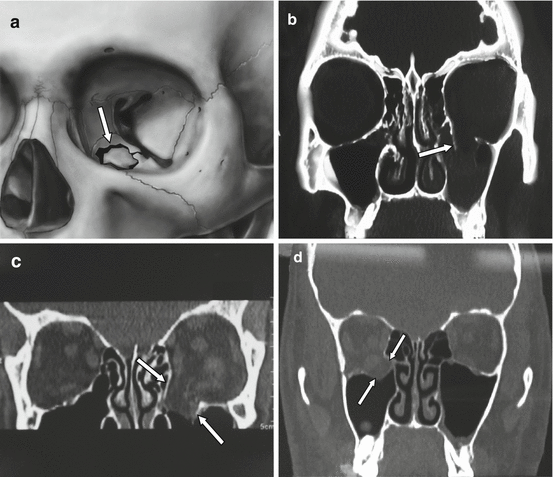 Orbital Floor Fractures Springerlink