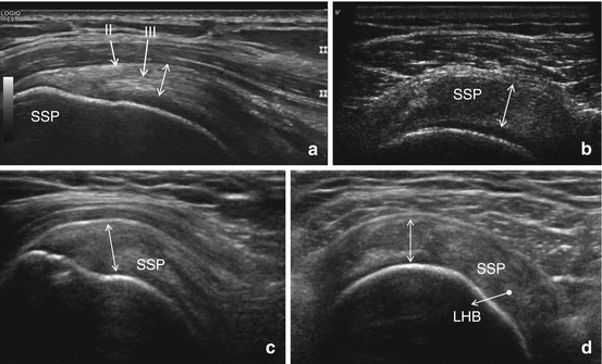 Shoulder Imaging | SpringerLink
