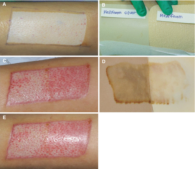 Interactive Wound Dressings SpringerLink