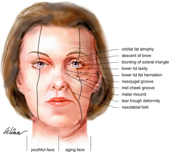 Lower Eyelid Blepharoplasty | SpringerLink