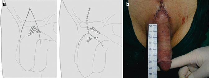 Ligament stretch penis Penis Exercises