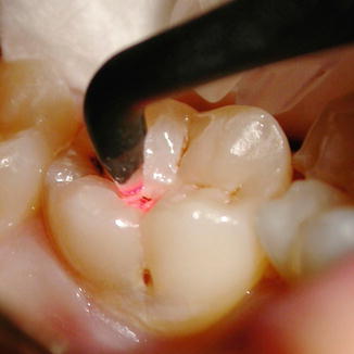 Laser Applications for Caries Diagnosis and Prevention | SpringerLink Laser Applications for Caries Diagnosis and Prevention | SpringerLink