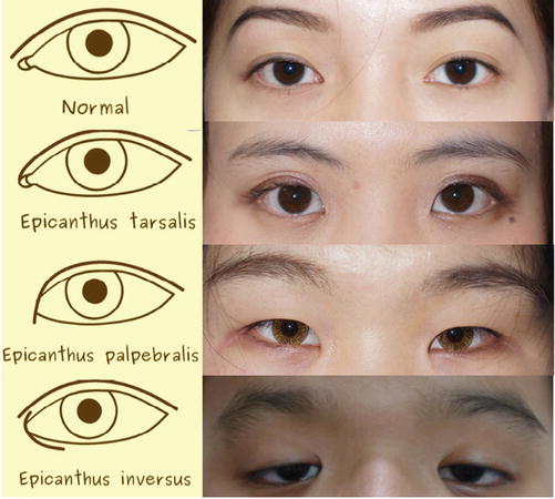 Update On Asian Eyelid Anatomy And Periocular Aging Change