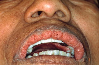diseases of the lips springerlink lip diseases