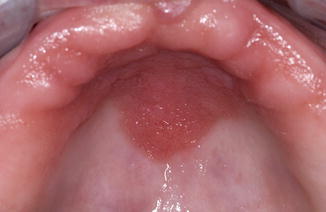 define palatal papillomatosis)