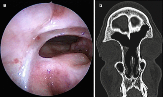 The Role Of Fungus In Diseases Of The Frontal Sinus Springerlink The Role Of Fungus In Diseases Of The Frontal Sinus Springerlink