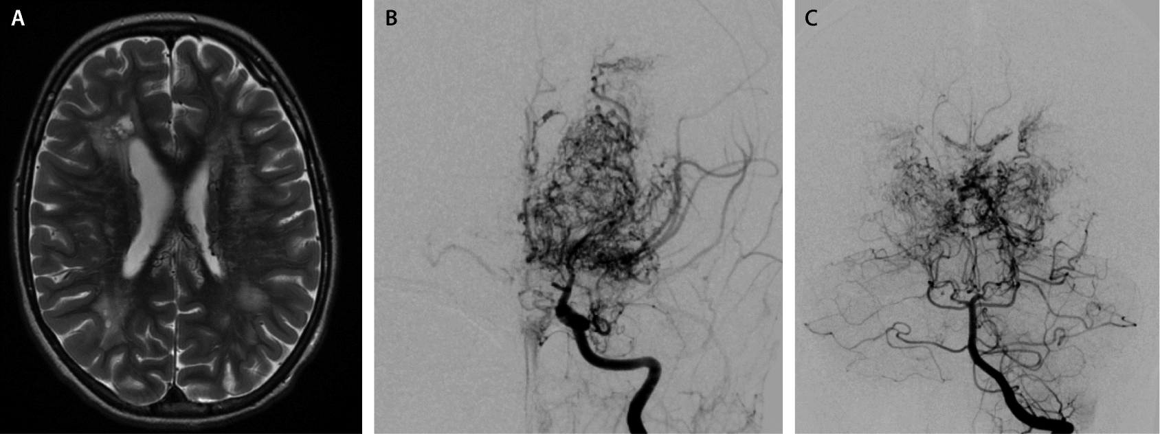 Moyamoya Erkrankung Springerlink