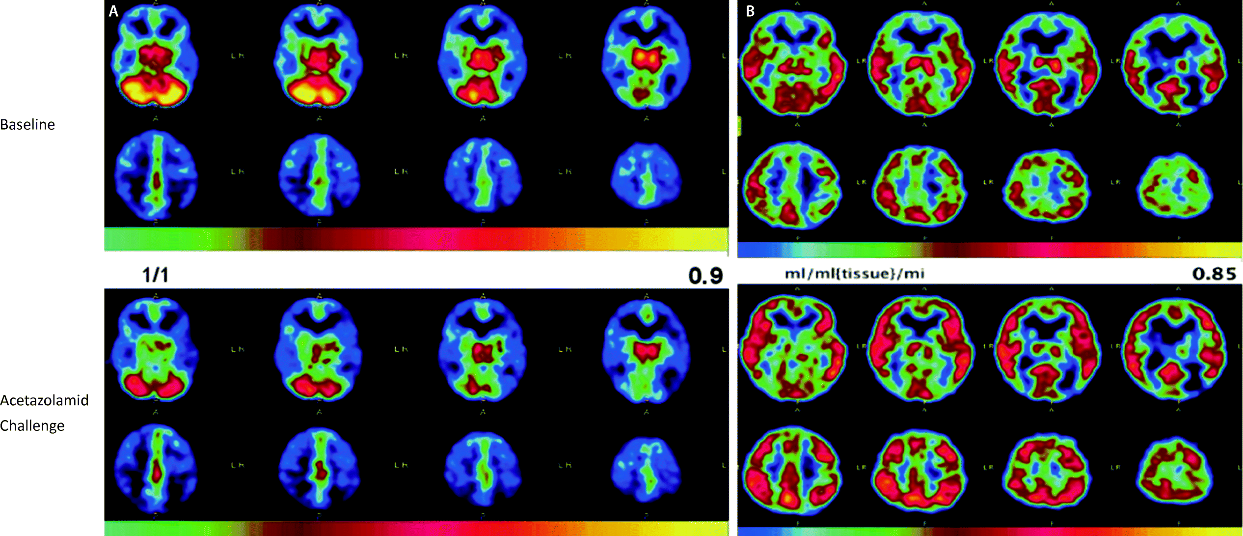 Moyamoya Erkrankung Springerlink
