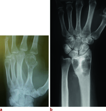 Riesenzelltumor Osteoklastom Des Handskeletts Springerlink