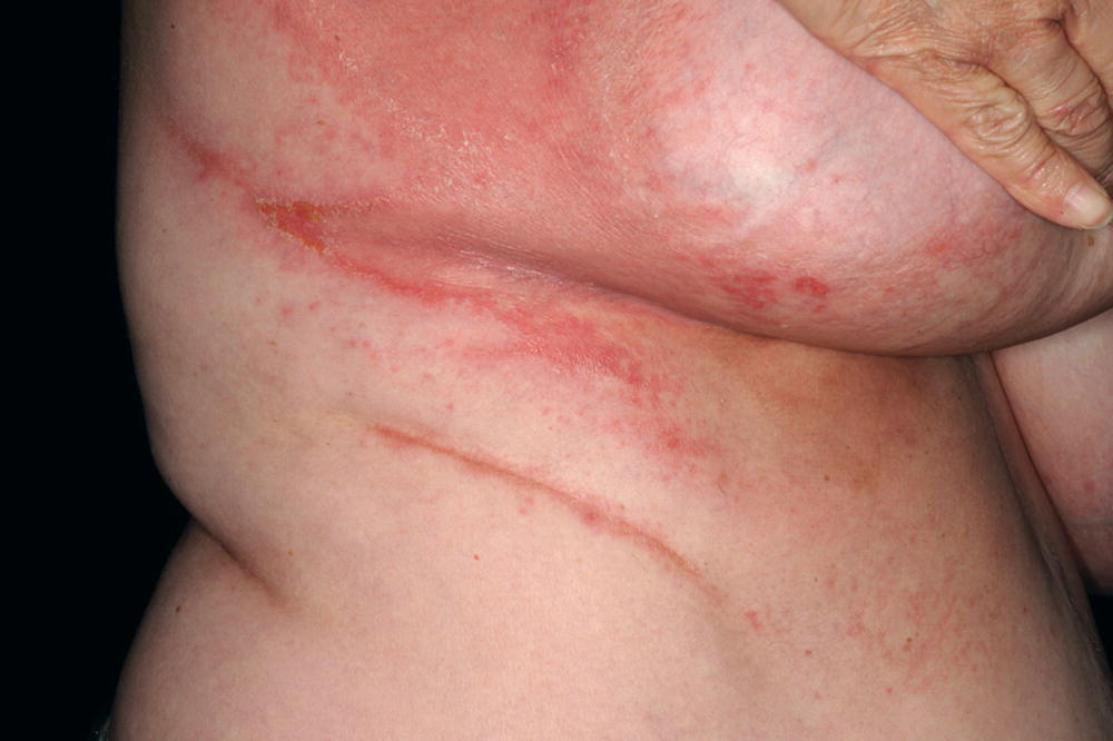 Intertrigo unter der brust