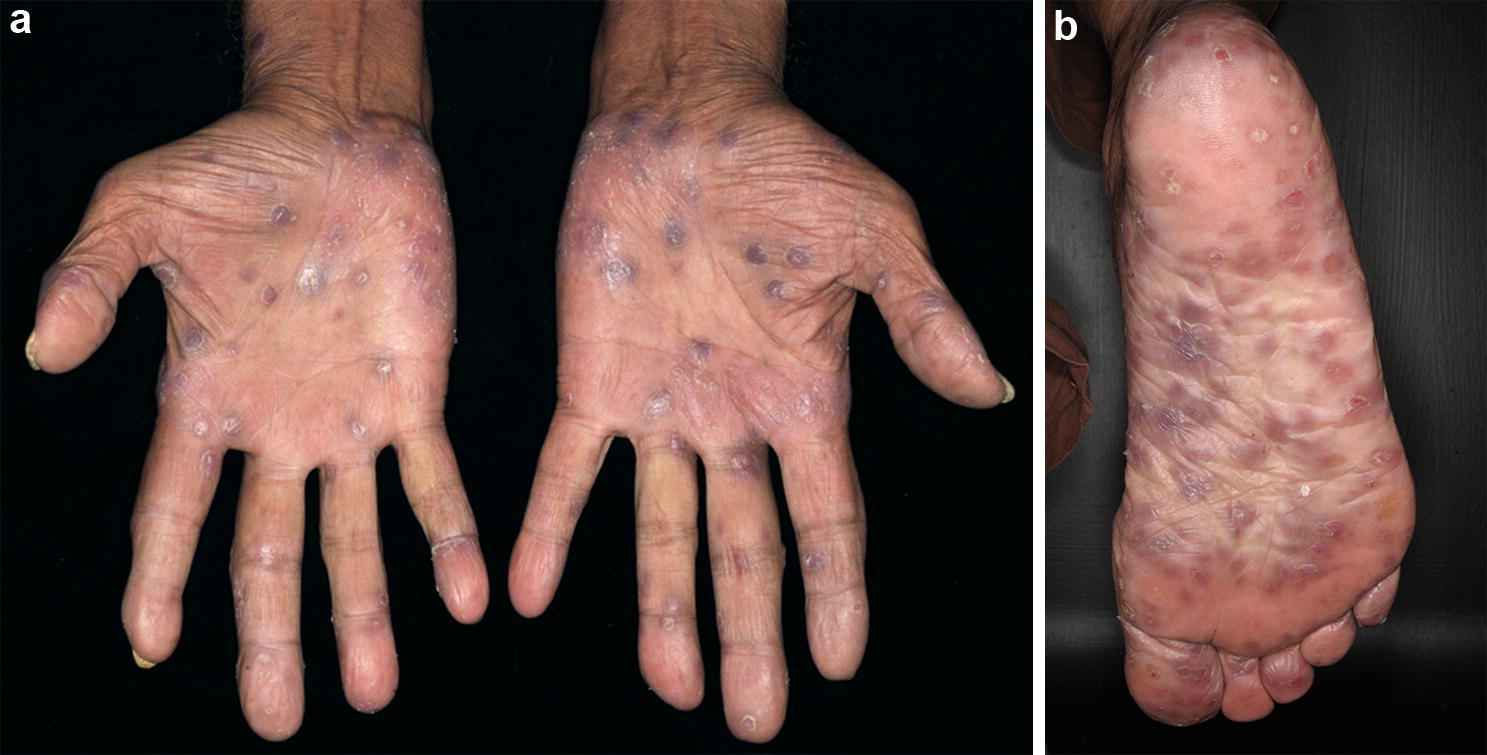 Penis pigmentstörung Category:Vitiligo