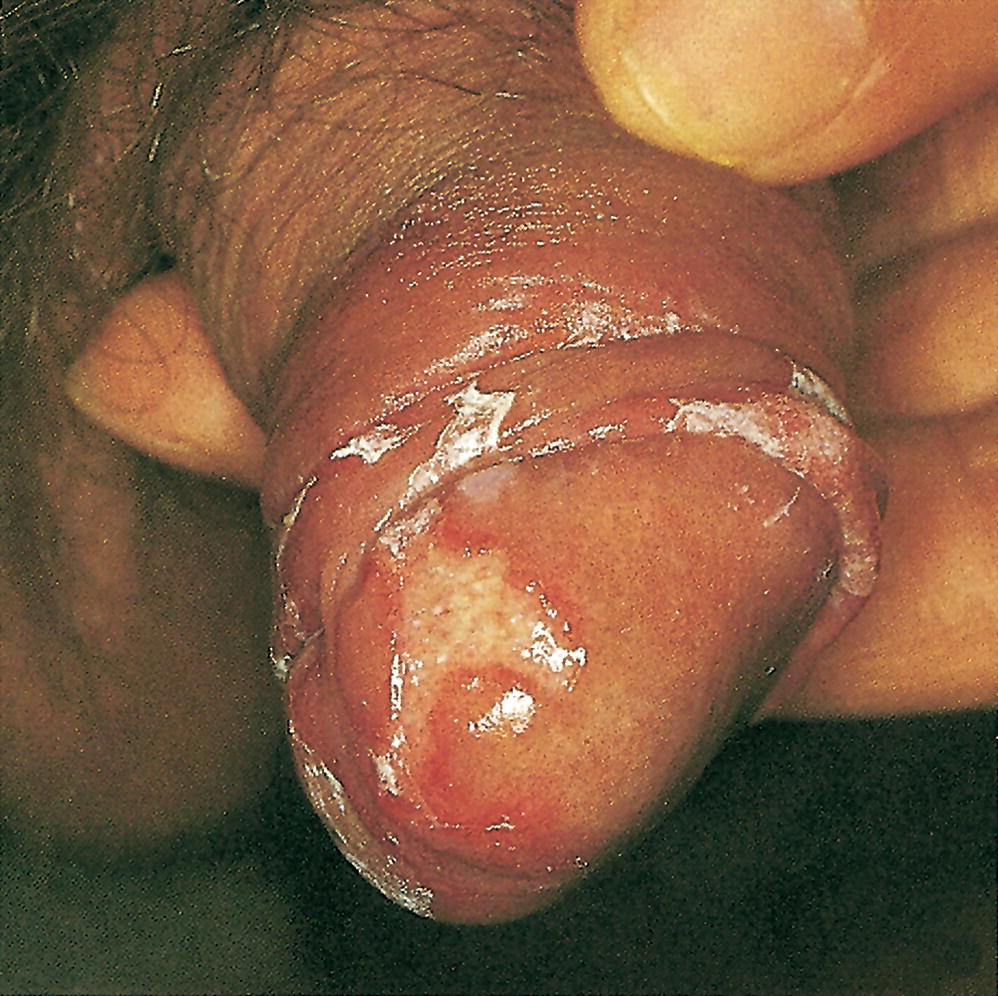 hefe infektion anal