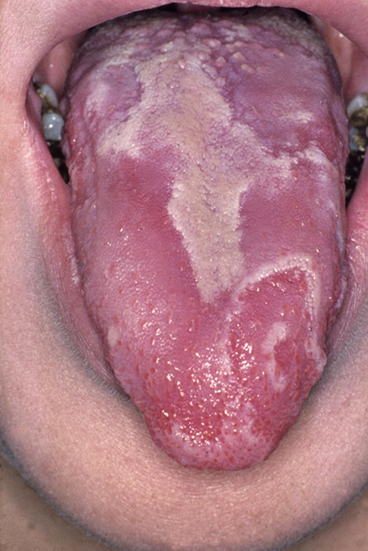 Erkrankungen der Lippen und der Mundhöhle SpringerLink
