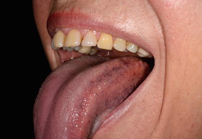 Zunge der knötchen auf Belegte oder