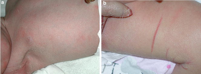 Neonatale Dermatologie Springerlink