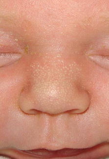 Neonatale Dermatologie Springerlink