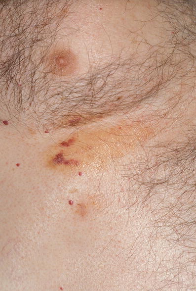 Petechien nach kratzen