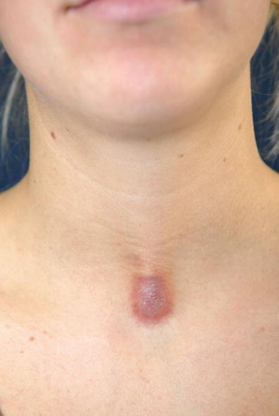 Zysten Und Pseudozysten Der Haut Springerlink Zysten Und Pseudozysten Der Haut Springerlink