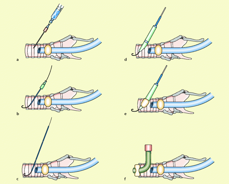 Intubation Tracheotomie Und Pflege Des Beatmeten Patienten SpringerLink intubation-tracheotomie-und-pflege-des-beatmeten-patienten-springerlink