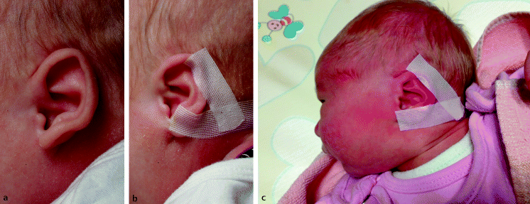 Ohrmuschelkorrektur beim Neugeborenen mit der Pflastermethode | SpringerLink