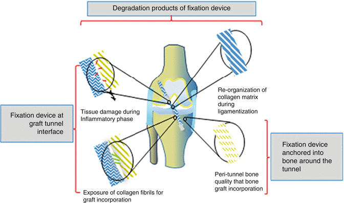 Pros And Cons Of Different ACL Graft Fixation Devices 