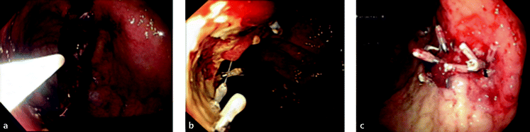 Endoskopische Therapie In Der Palliativsituation Des Magen - 