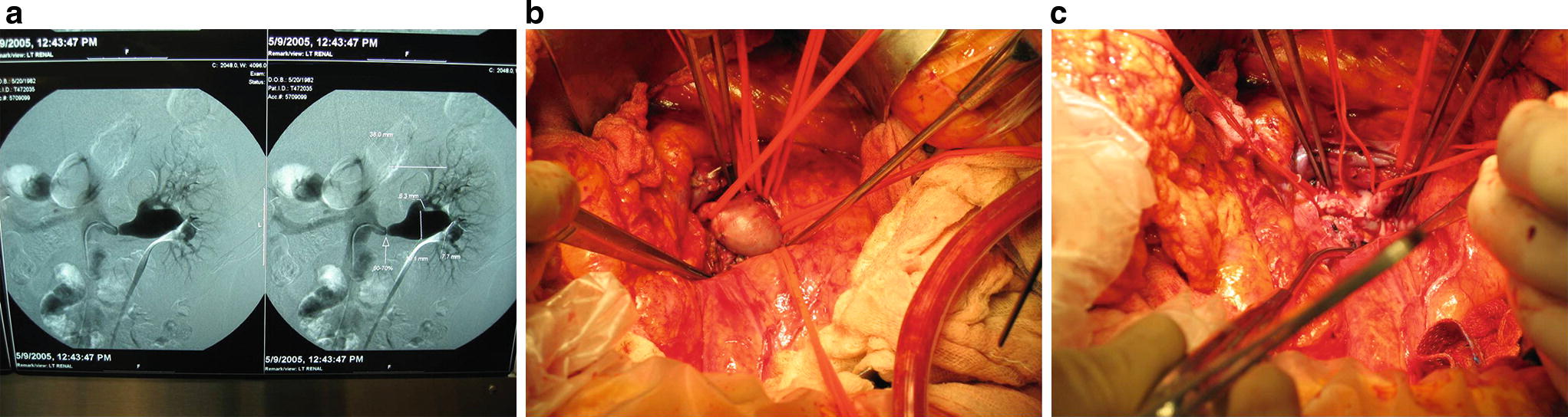 Aneurysmatische Gefasserkrankungen Terminologie Atiologie Und Lokalisation Springerlink