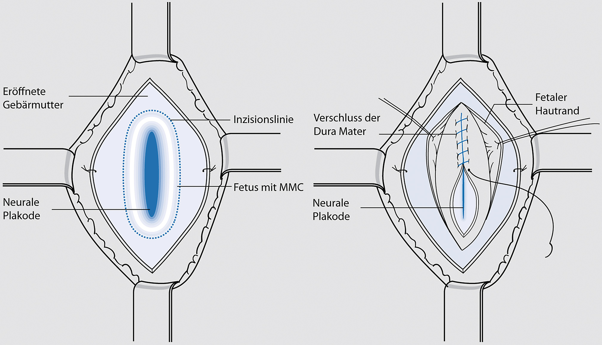 Fetale herzfrequenz nach 26 wochen