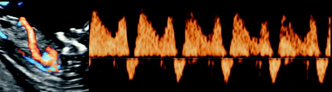 Schwangerschaftsdatierung Ultraschall vs lmp