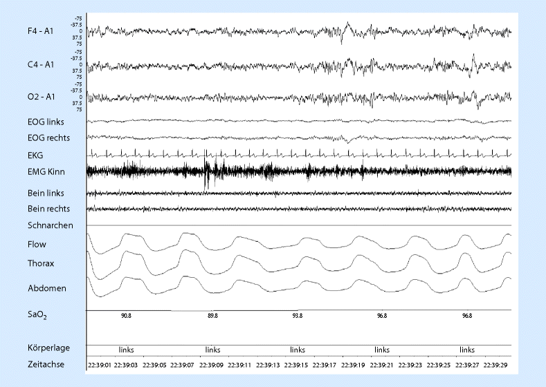 Physiologische Grundlagen Des Normalen Und Gestorten Schlafes Springerlink