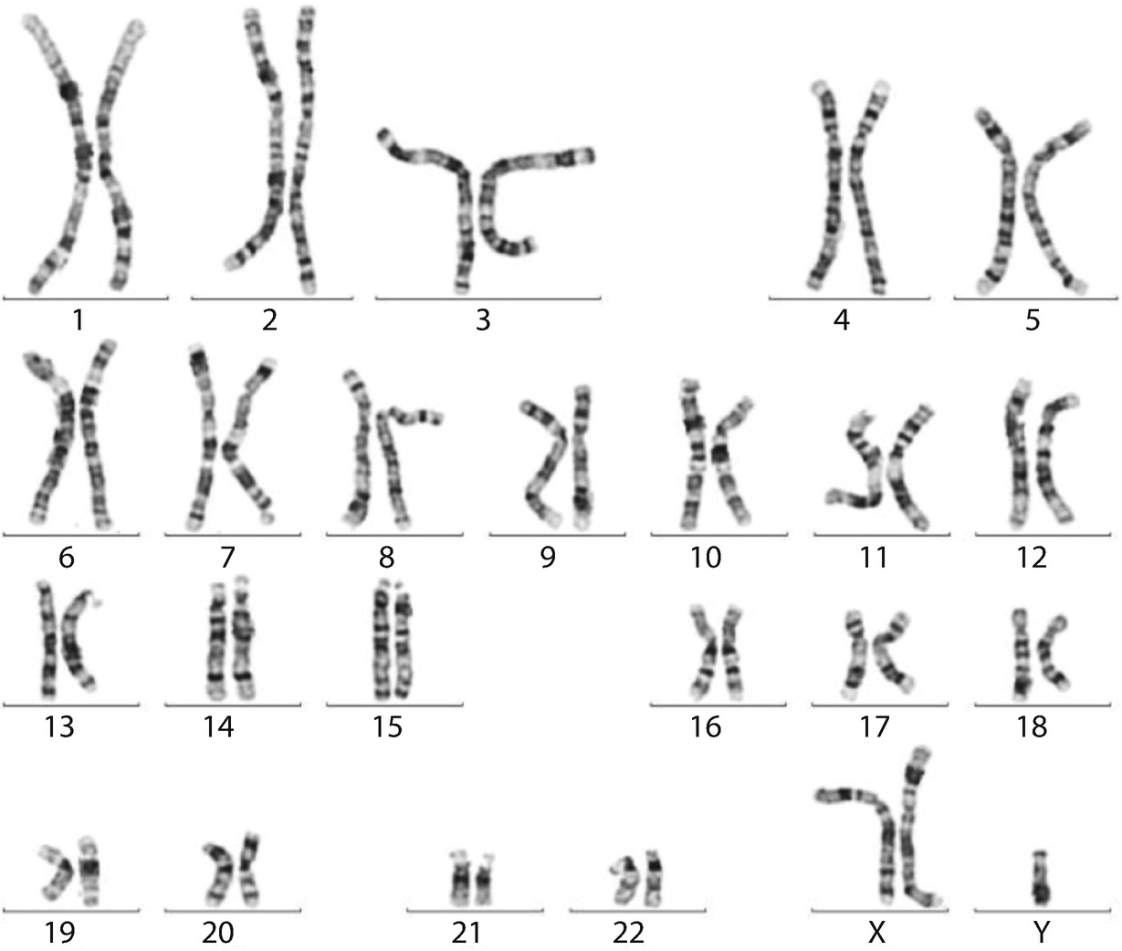 Genetische Erkrankungen Syndromologie Springerlink