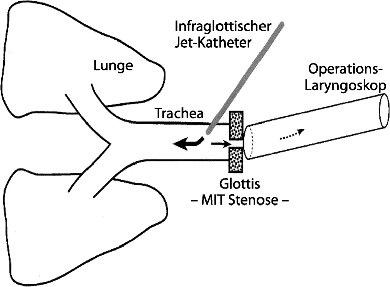 Jetventilation Beim Schwierigen Atemweg Springerlink