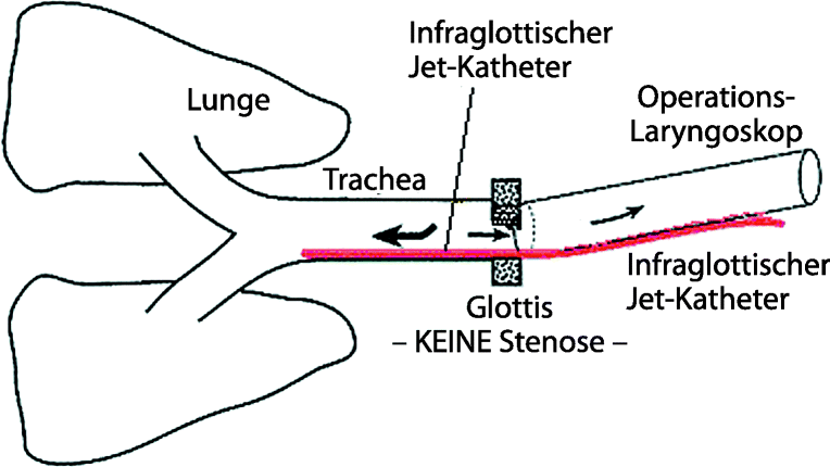 Jetventilation Beim Schwierigen Atemweg Springerlink