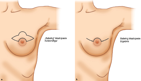 Onkoplastische Chirurgie Springerlink