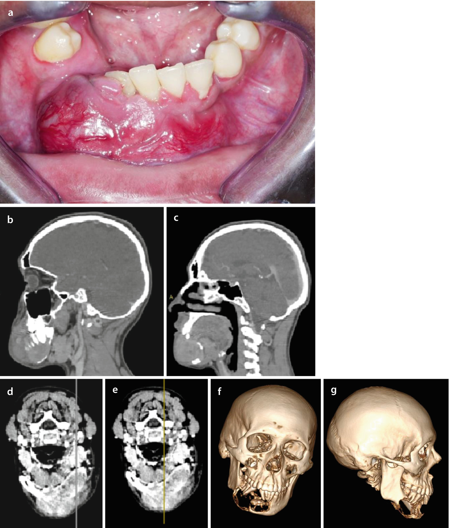 Digitale Volumentomographie Zur Diagnostik Bei Tumoren Springerlink