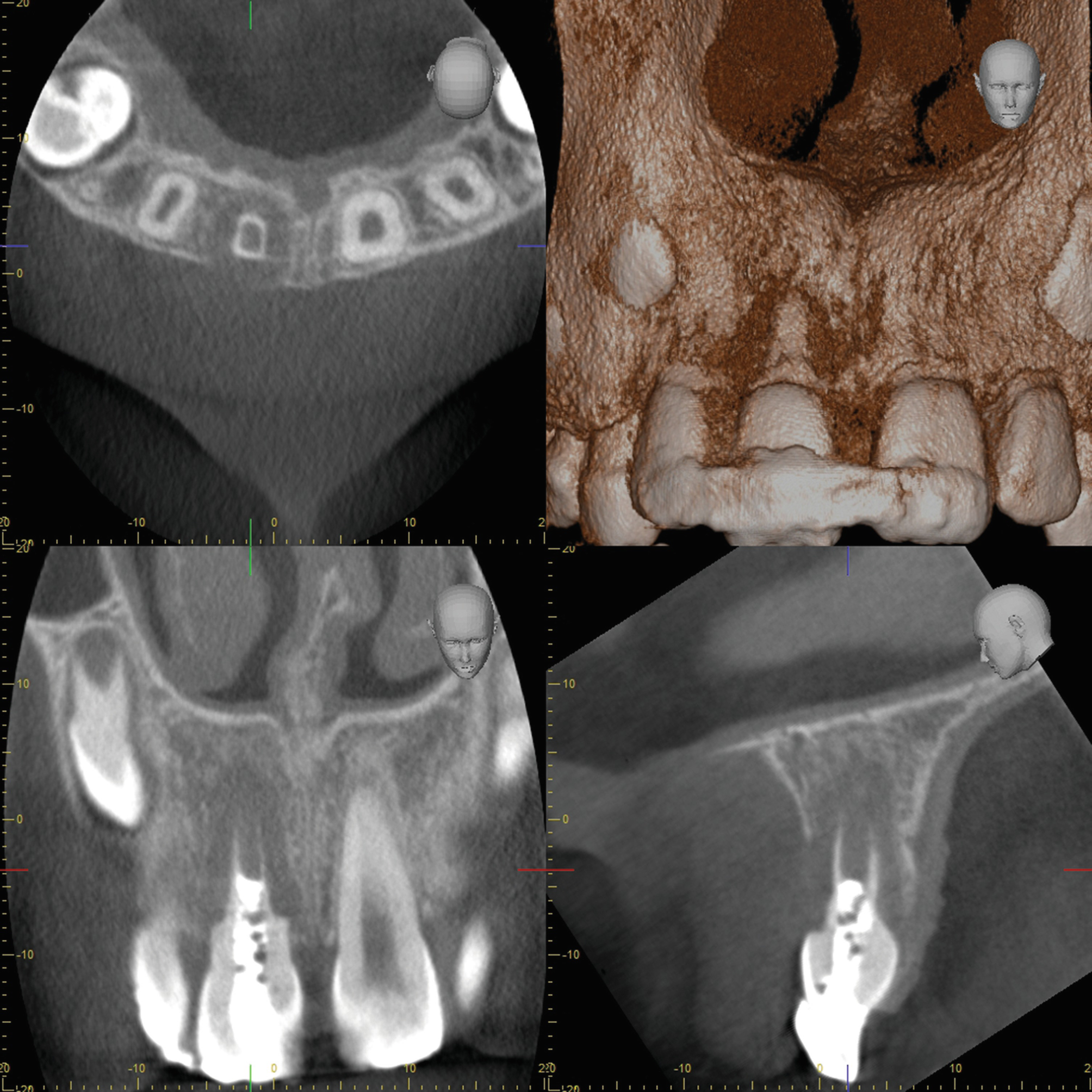 Digitale Volumentomographie Zur Diagnostik Von Pathologischen Befunden Der Zahne Springerlink