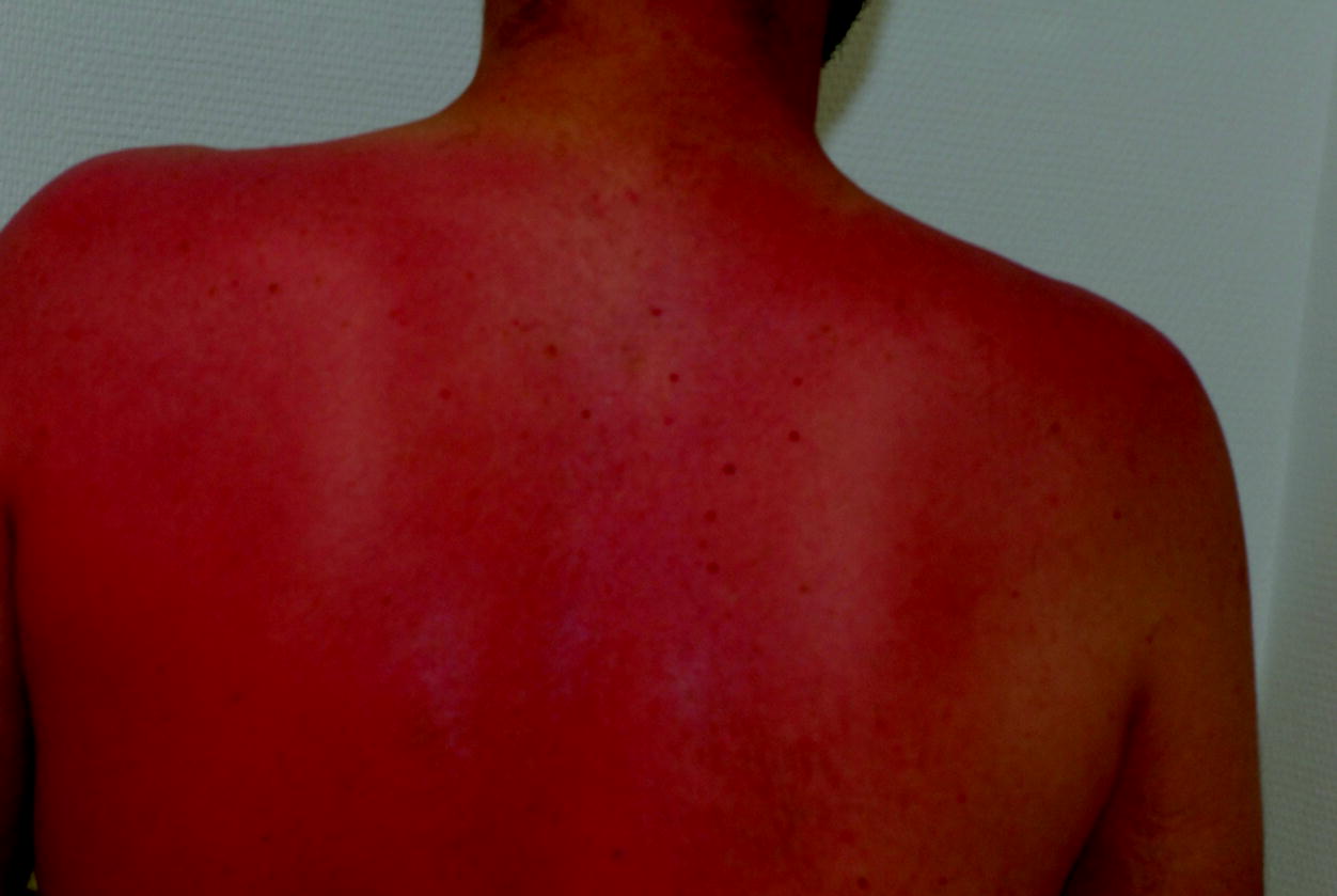 Sonnenbrand Springerlink