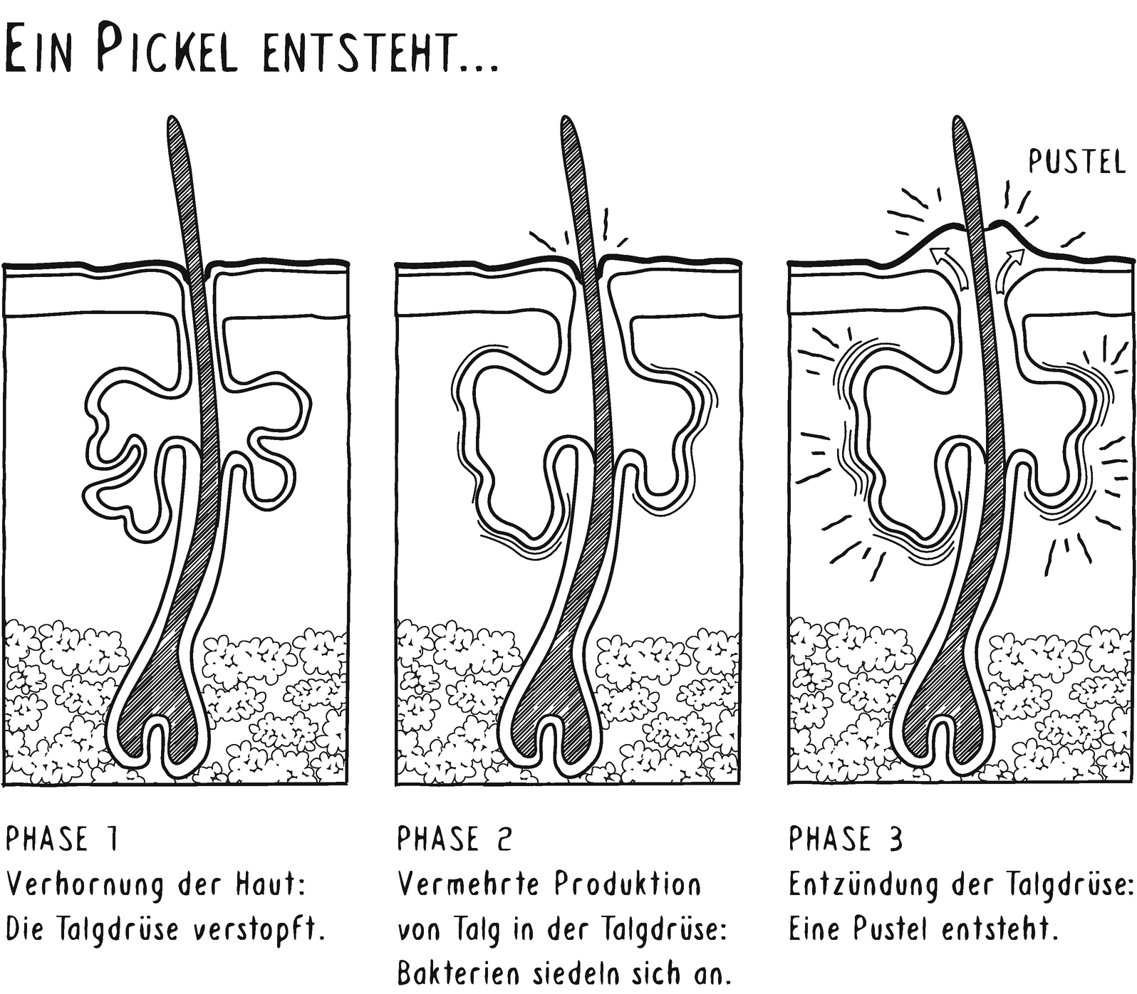 Ich Habe Pickel Und Akne Ungeliebte Mitesser Springerlink