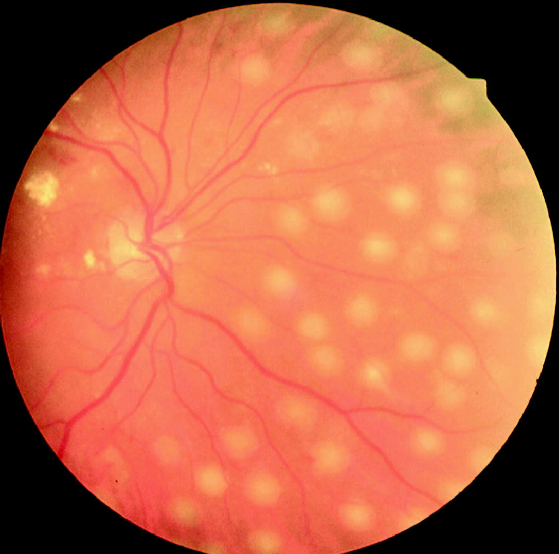 Laserbehandlungen des Auges | SpringerLink