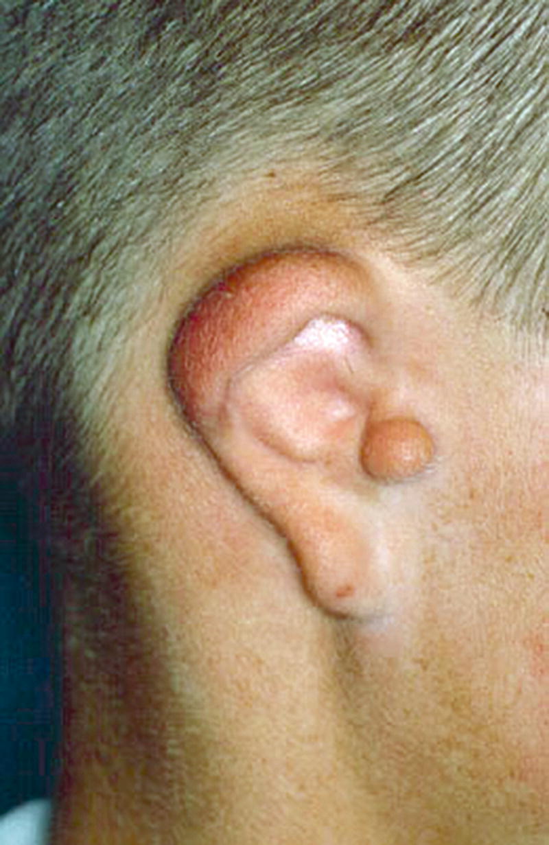 Krankheiten des äußeren Ohrs | SpringerLink