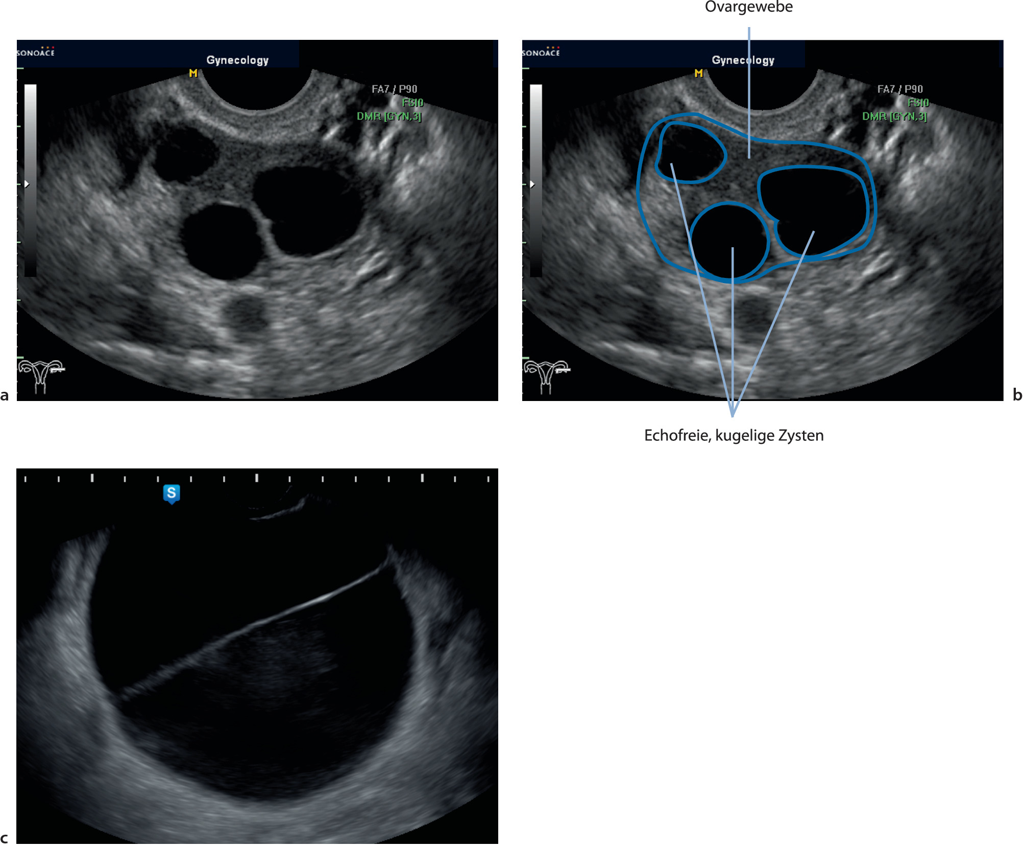 Positiver schwangerschaftstest durch zyste