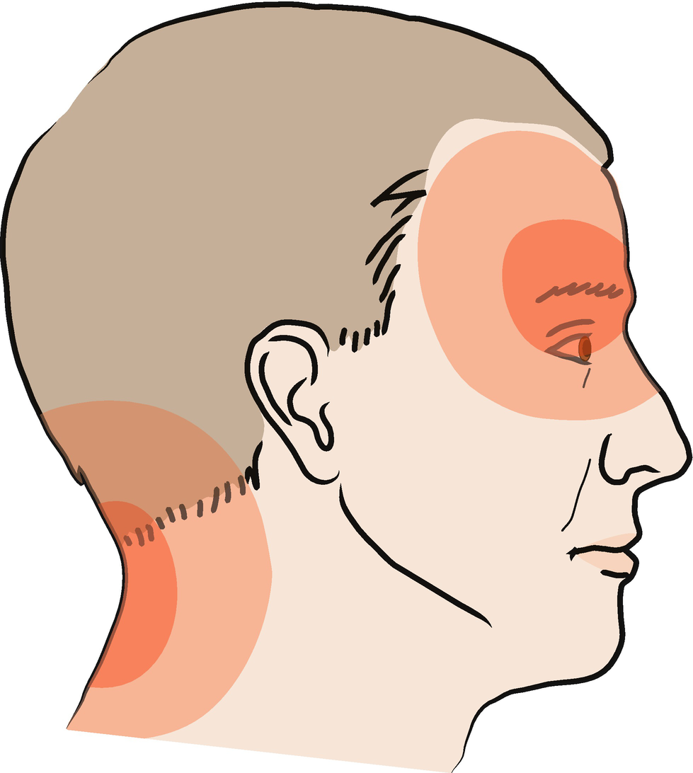 Manuelle Lymphdrainage zur Behandlung verschiedener Kopfschmerzsyndrome |  SpringerLink