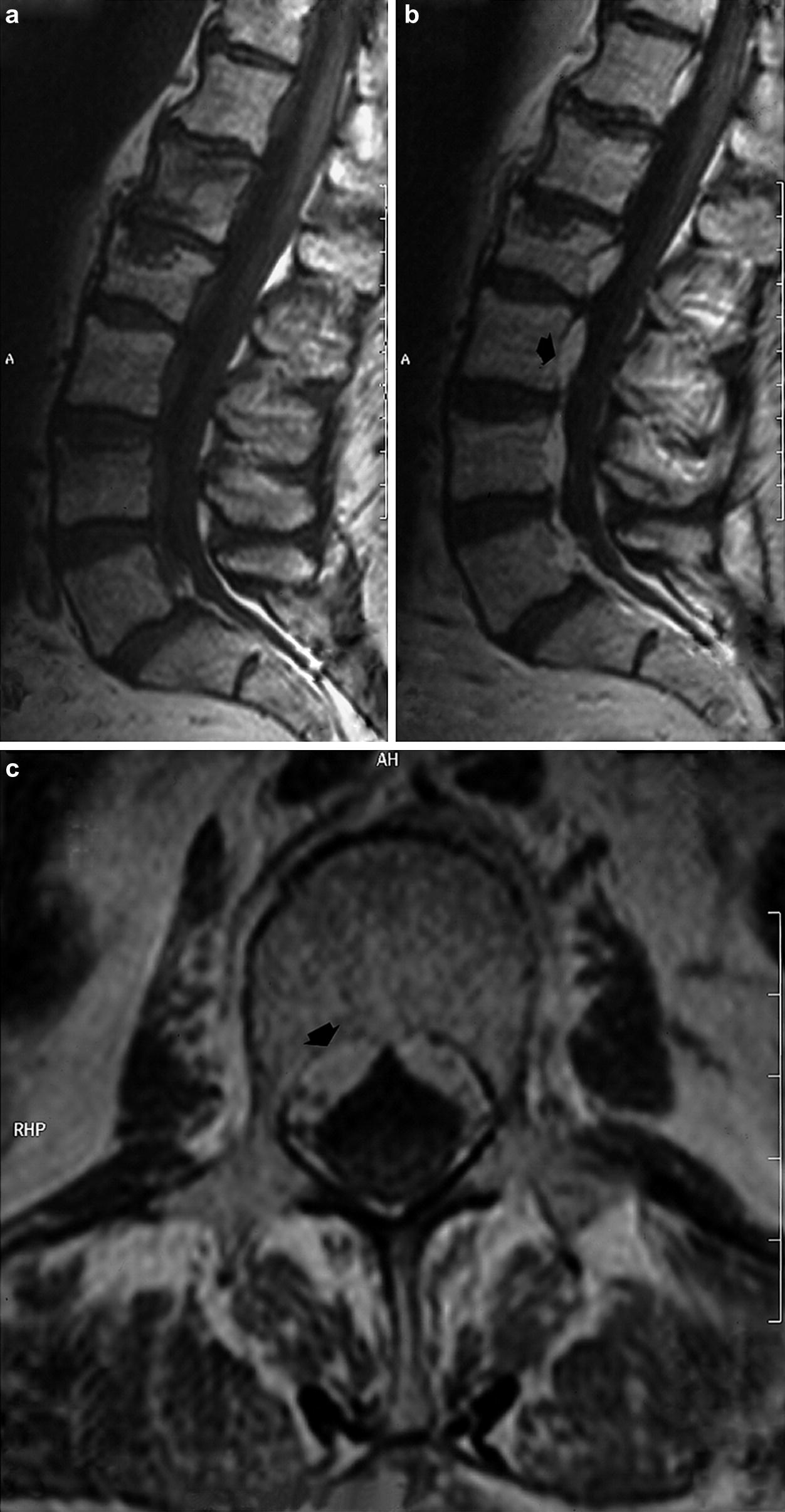 Entzundliche Ruckenmarkerkrankungen Springerlink