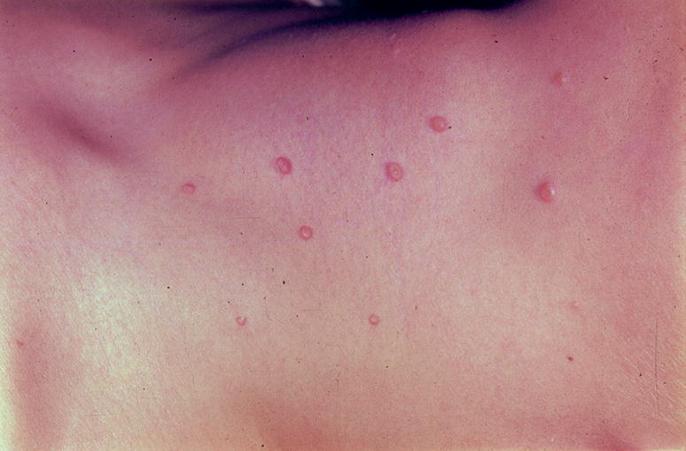 boala condilomului cum se tratează îndepărtați papilomul de pe piele