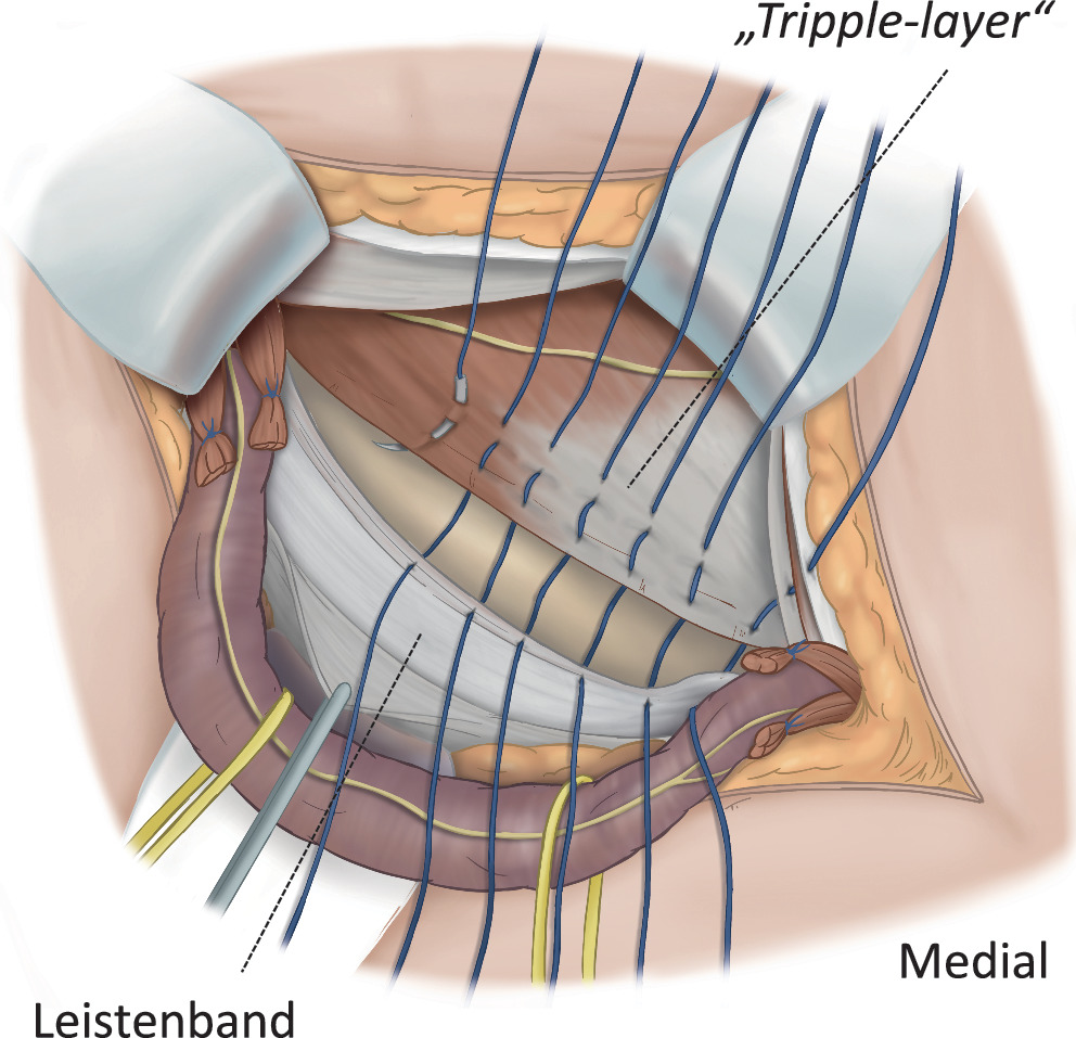 Leistenhernienreparation Nach Bassini Springerlink