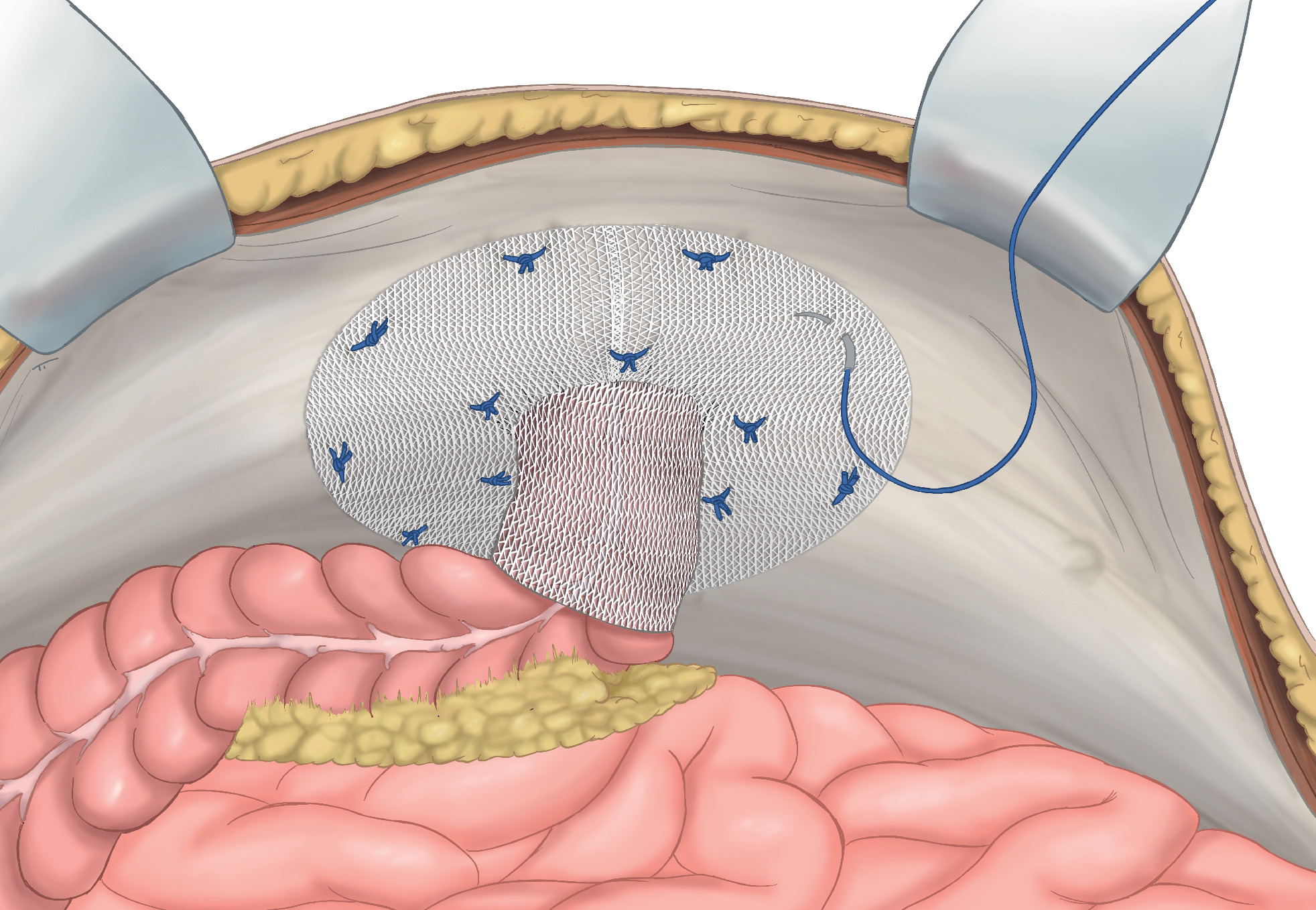 Parastomale Hernien Ubersicht Therapiewahl Und Ipst Verfahren Springerlink